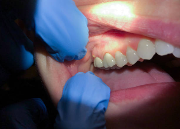 Best Emergency Dental Care for Broken or Chipped Teeth in Northwood, IA
